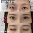 二重全切開フルコース・眼瞼下垂修正手術 before画像 サムネイル用