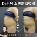 お腹腰脂肪吸引 before画像 サムネイル用