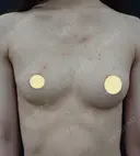 アキ―セル併用コンデンスリッチ脂肪豊胸＋BANNAI式オリジナル３D注入法＋ベイザー＆シリンジ法 before画像 サムネイル用