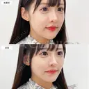 【Aスレッド(繊維)】わずか15分でもたつき改善！処置前と直後の症例です before画像 サムネイル用
