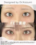 フォーエバー二重術 after画像 サムネイル用