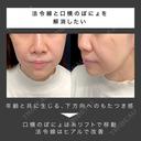 アプリリフト8本＋ヒアルロン酸（法令線＋鼻翼基部） before画像 サムネイル用