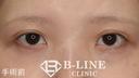 【目頭切開術(Z形成)】 手術直後 before画像 サムネイル用
