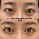 目頭切開＋目尻切開＋目尻靱帯移動 30日後 サムネイル用