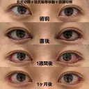 目頭切開＋目尻切開＋目尻靱帯移動 after画像 サムネイル用