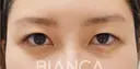 皮膚を持ち上げ平行二重へ before画像 サムネイル用