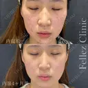 ニキビ治療 after画像 サムネイル用