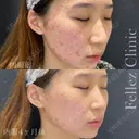 ニキビ治療 before画像 サムネイル用