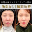 アプリリフト12本＋ヒアルロン酸(頬＋法令線＋あご)＋ボツリヌス注射(あご) 14日後 サムネイル用