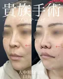 人中短縮、口角挙上、貴族手術 before画像 サムネイル用