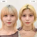 【1day小顔】2ヶ月後には理想のVフェイスが完成！処置前と2ヶ月後の症例です before画像 サムネイル用