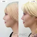 【1day小顔】2ヶ月後には理想のVフェイスが完成！処置前と2ヶ月後の症例です 60日後 サムネイル用