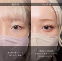 二重埋没・目頭切開 after画像 サムネイル用
