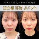 アプリリフト12本＋ヒアルロン酸(基部) 30日後 サムネイル用