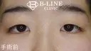 【二重全切開+目頭切開術(Z形成)】3ヶ月後 before画像 サムネイル用