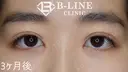 【二重全切開+目頭切開術(Z形成)】3ヶ月後 after画像 サムネイル用