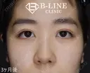 【二重全切開+目頭切開術(Z形成)】3ヶ月後 after画像 サムネイル用