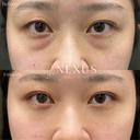 切らない目の下のたるみ取り＋脂肪注入 after画像 サムネイル用