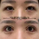全切開＋眼瞼下垂修正＋グラマラスライン結膜切開＋目尻切開＋目尻靱帯移動＋裏ハムラ before画像 サムネイル用