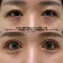 全切開＋眼瞼下垂修正＋グラマラスライン結膜切開＋目尻切開＋目尻靱帯移動＋裏ハムラ 30日後 サムネイル用