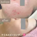 ケミカルピーリング  after画像 サムネイル用