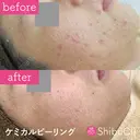 ケミカルピーリング  before画像 サムネイル用