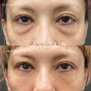 裏ハムラ法＋脂肪注入 after画像 サムネイル用