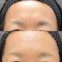 額ボトックス before画像 サムネイル用