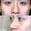 鼻翼縮小(糸) before画像 サムネイル用