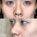鼻翼縮小(糸) after画像 サムネイル用