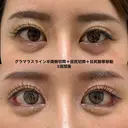 グラマラスライン半両側切開＋目尻切開＋目尻靱帯移動 before画像 サムネイル用