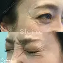 目尻ボトックス before画像 サムネイル用