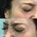 目尻ボトックス after画像 サムネイル用
