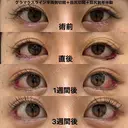 グラマラスライン半両側切開＋目尻切開＋目尻靱帯移動 21日後 サムネイル用
