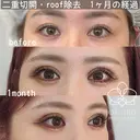 二重全切開フルコース・roof脂肪除去 before画像 サムネイル用