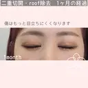 二重全切開フルコース・roof脂肪除去 30日後 サムネイル用
