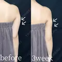 二の腕・肩・セット　脂肪吸引 after画像 サムネイル用