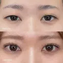 二重埋没(クイックシンデレラ・トリプル) before画像 サムネイル用