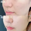 脂肪注入(ほうれい線) before画像 サムネイル用