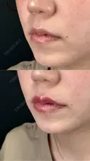 ヒアルロン酸/1cc /唇・涙袋・鼻翼基底部 before画像 サムネイル用