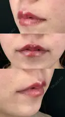 ヒアルロン酸/1cc /唇・涙袋・鼻翼基底部 after画像 サムネイル用