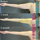 二の腕脂肪吸引 after画像 サムネイル用