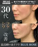 糸リフト【ブルーローズリフト】1０本 after画像 サムネイル用