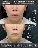 糸リフト【ブルーローズリフト】12本 ＋ ヒアルロン酸  after画像 サムネイル用