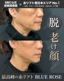 糸リフト【ブルーローズリフト】14本 ＋ ヒアルロン酸  after画像 サムネイル用