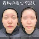 貴族手術(プロテーゼ) 90日後 サムネイル用