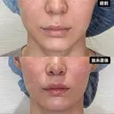 人中短縮 before画像 サムネイル用
