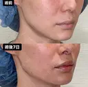 人中短縮 after画像 サムネイル用