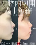 口腔内人中短縮 before画像 サムネイル用