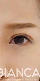 二重全切開で平行二重 after画像 サムネイル用